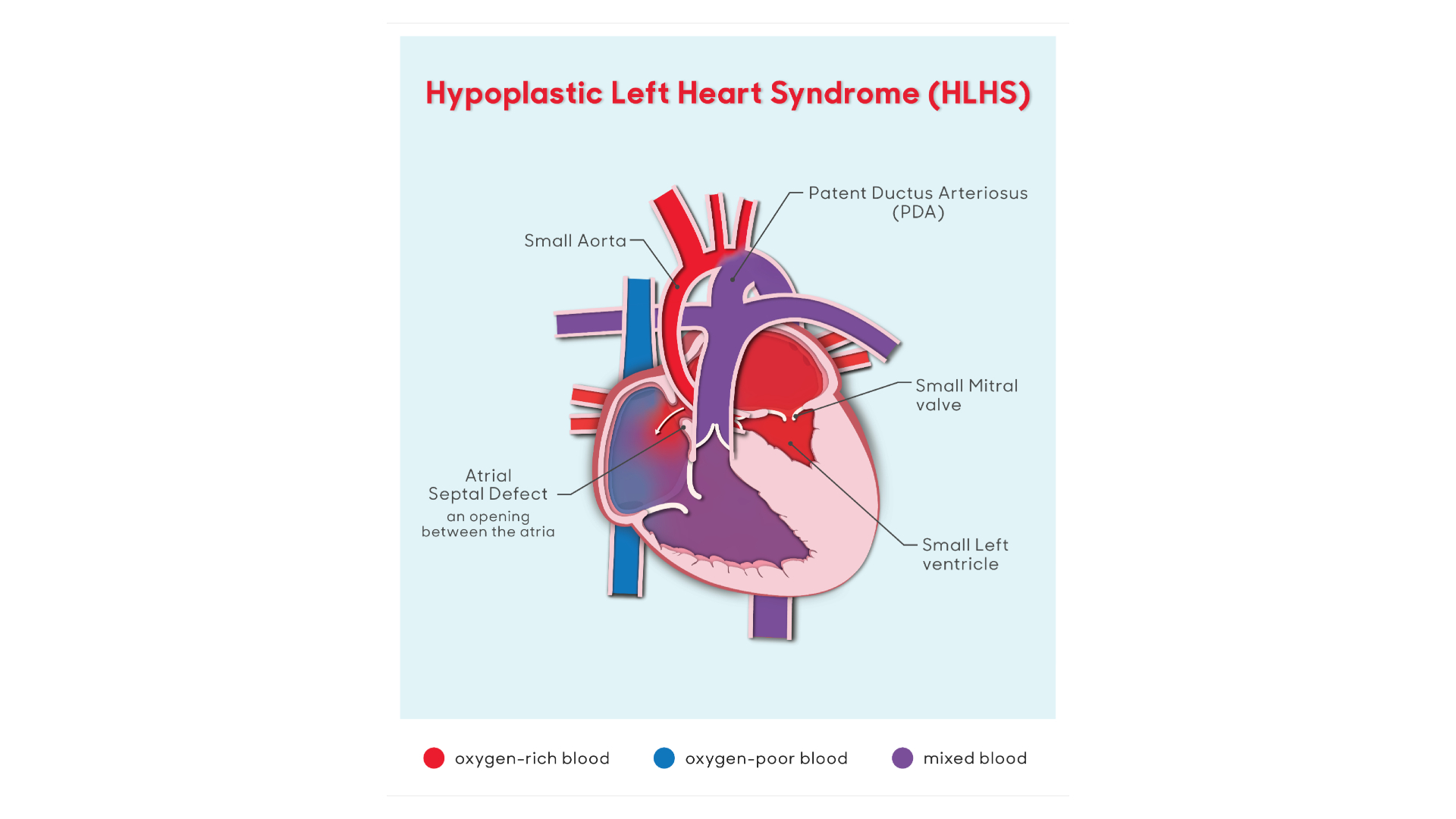 hlhs