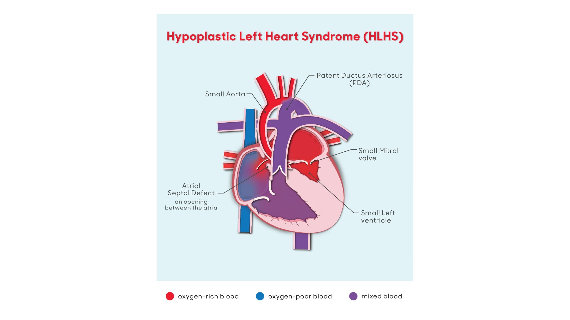 hlhs
