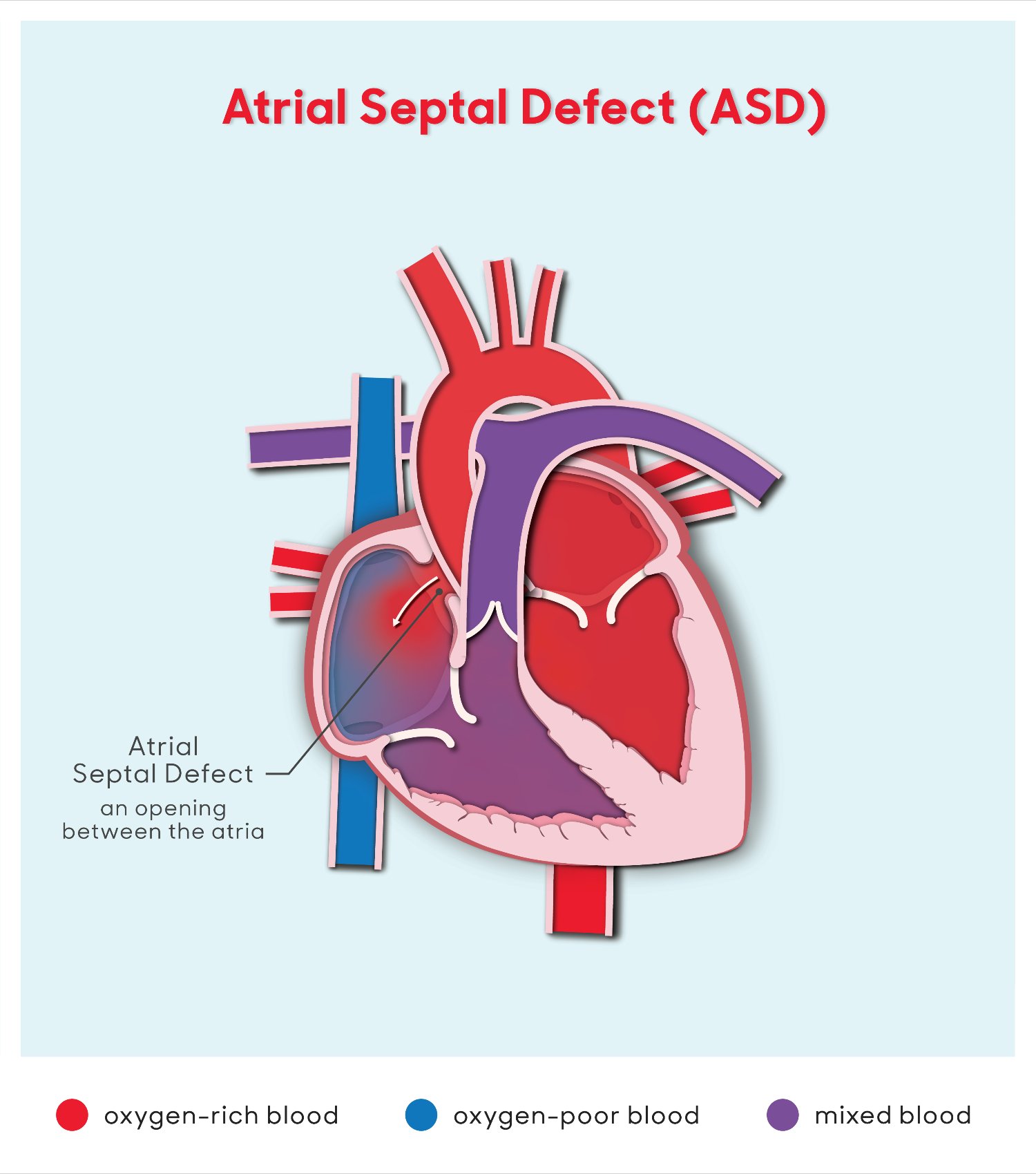 asd