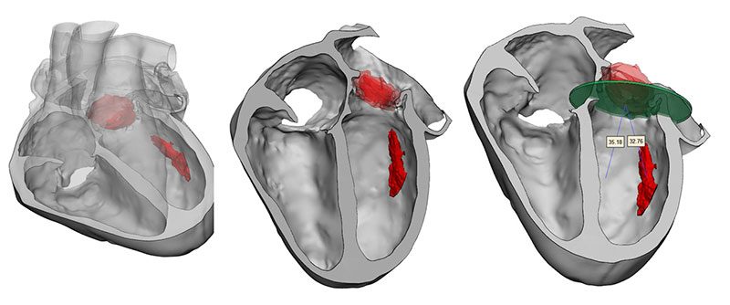 3D model for heart valve replacement planning