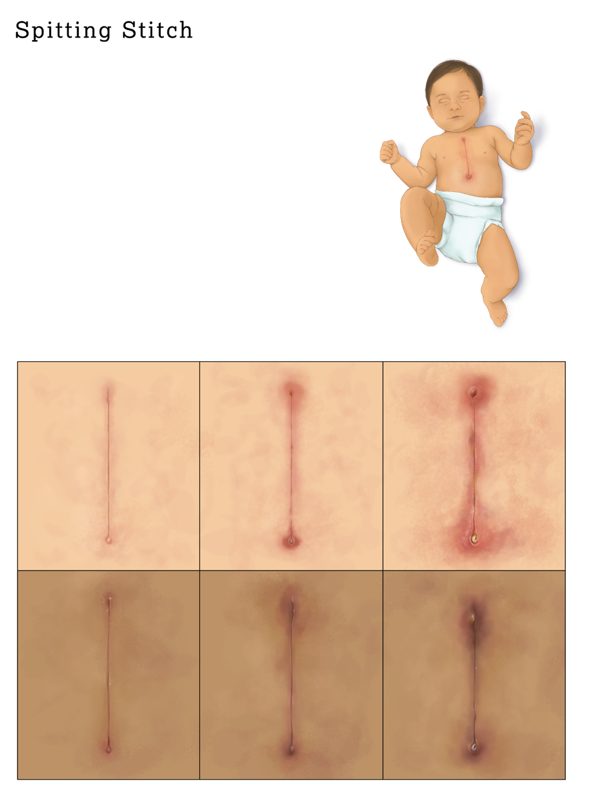 incision illustration