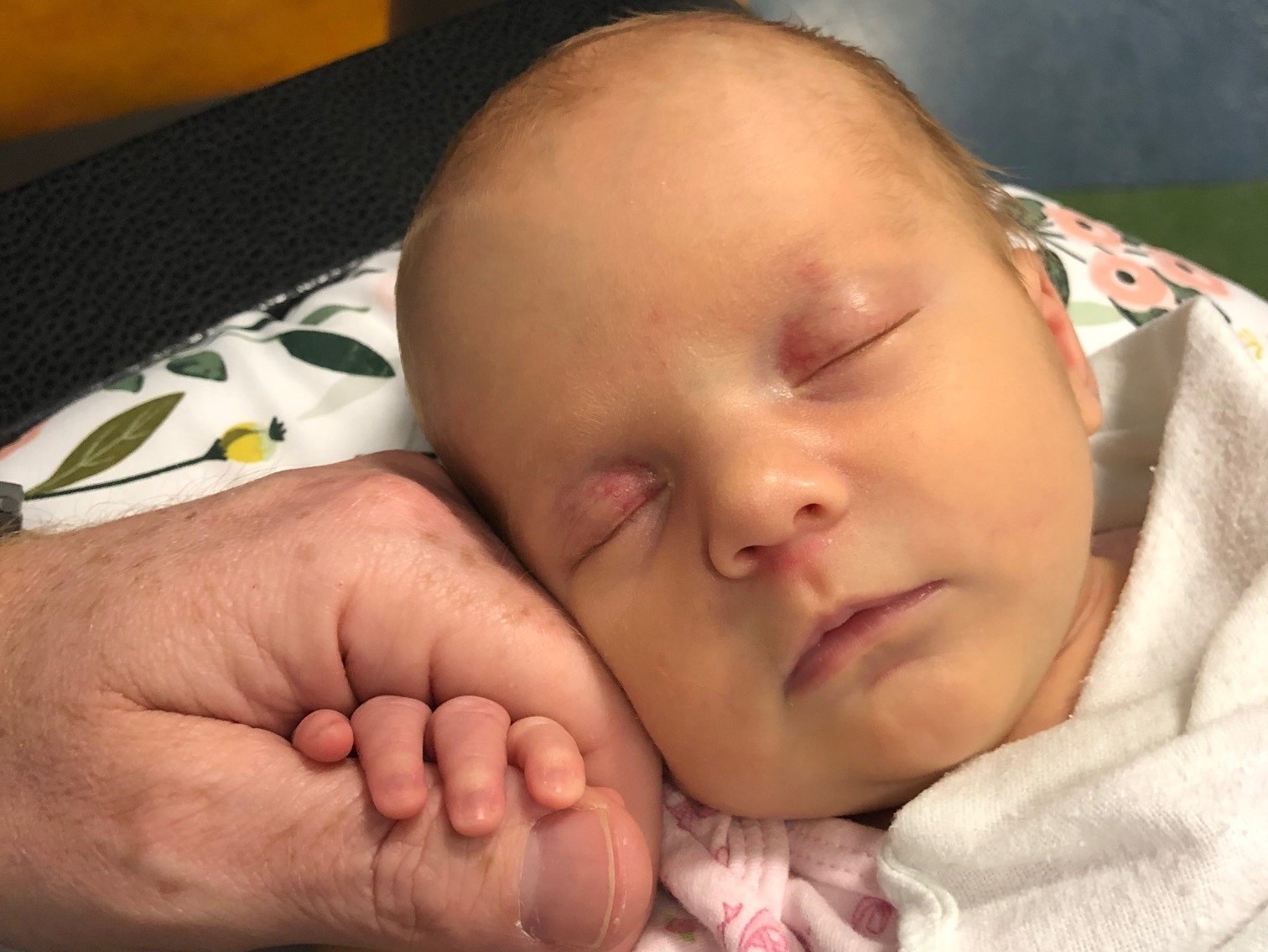 CNH patient, Fiona, as a sleeping infant holding her parent's hand.