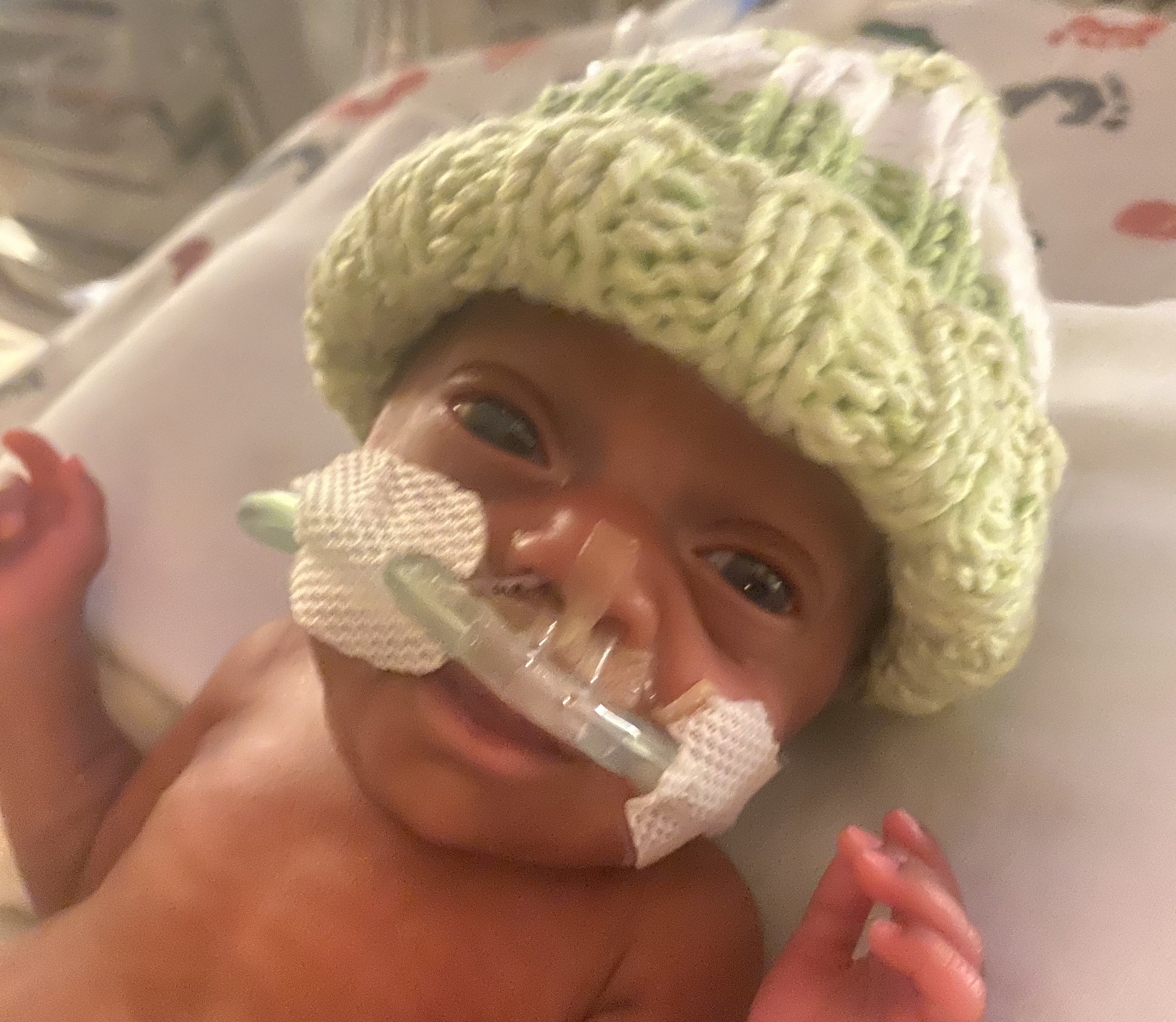 CNH patient, Trace, as an infant in the NICU.